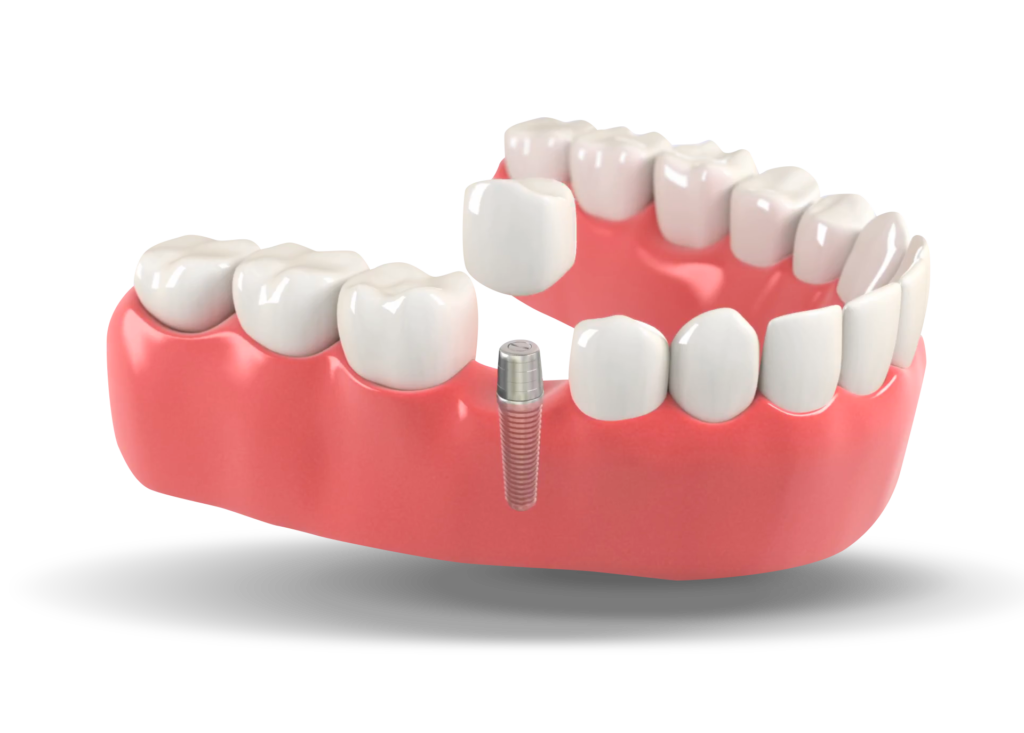 Dental implant Ocala, FL