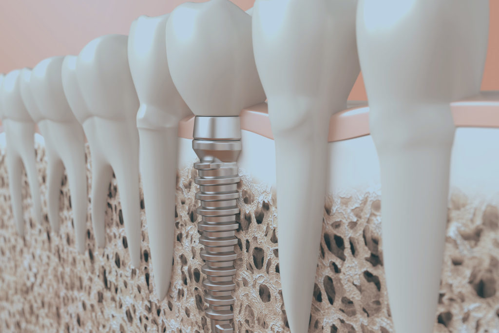 Bone grafting to treat severe bone loss Ocala, FL