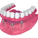 implant supported denture model Ocala , FL