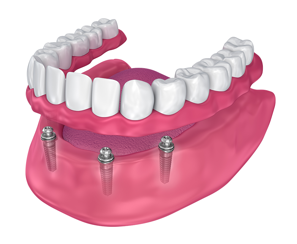 implant supported denture model Ocala , FL