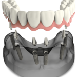 Full Arch Dental Implants - Ocala, FL