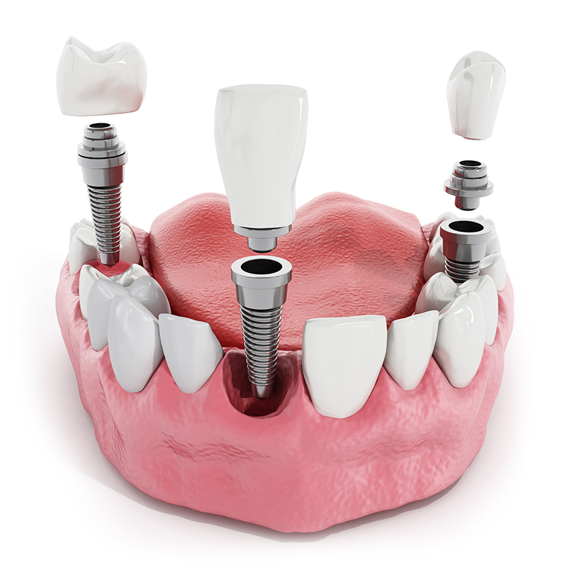multiple dental implants Ocala, FL
