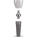 Single Dental Implant - Ocala, FL