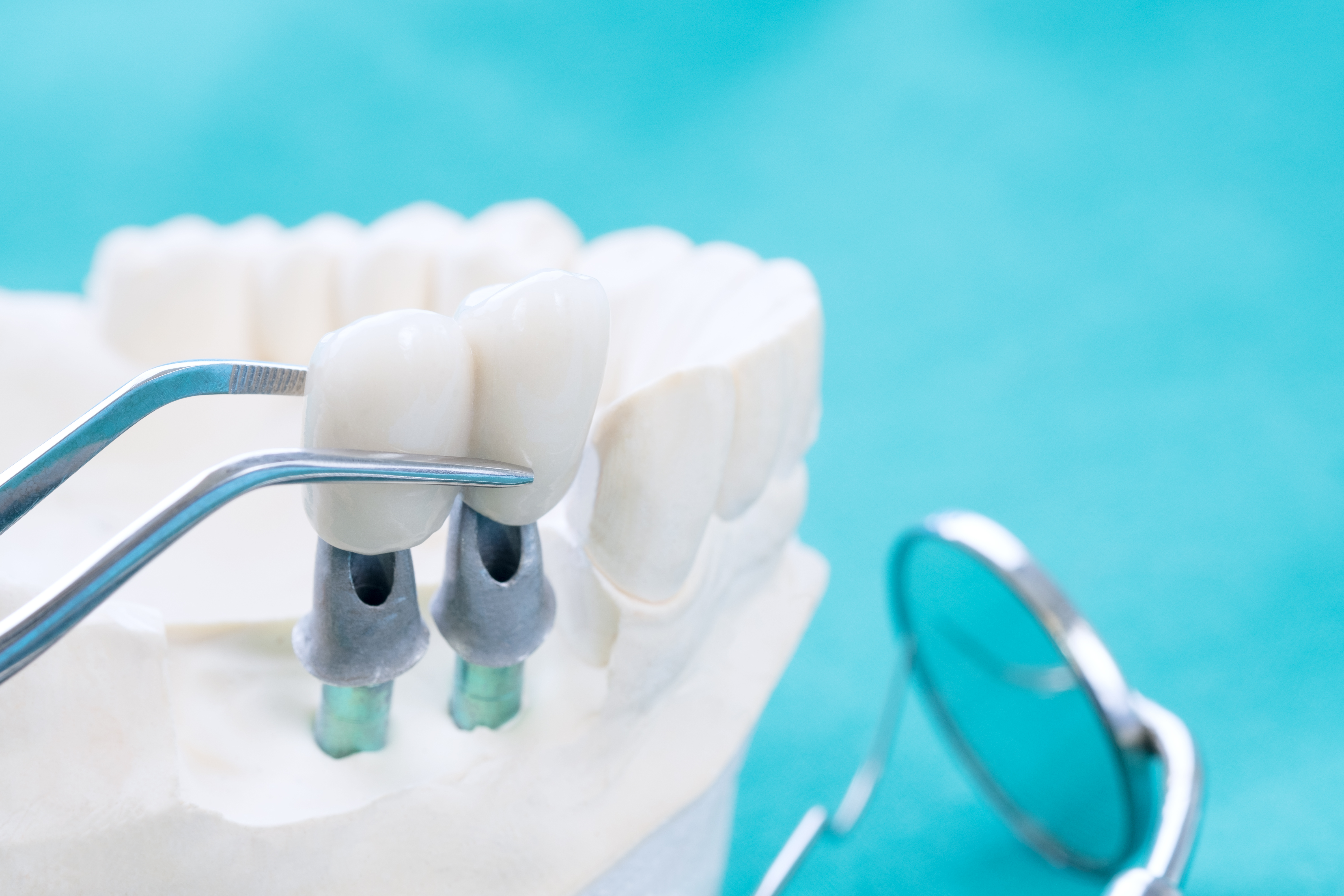 dental implants the villages fl
