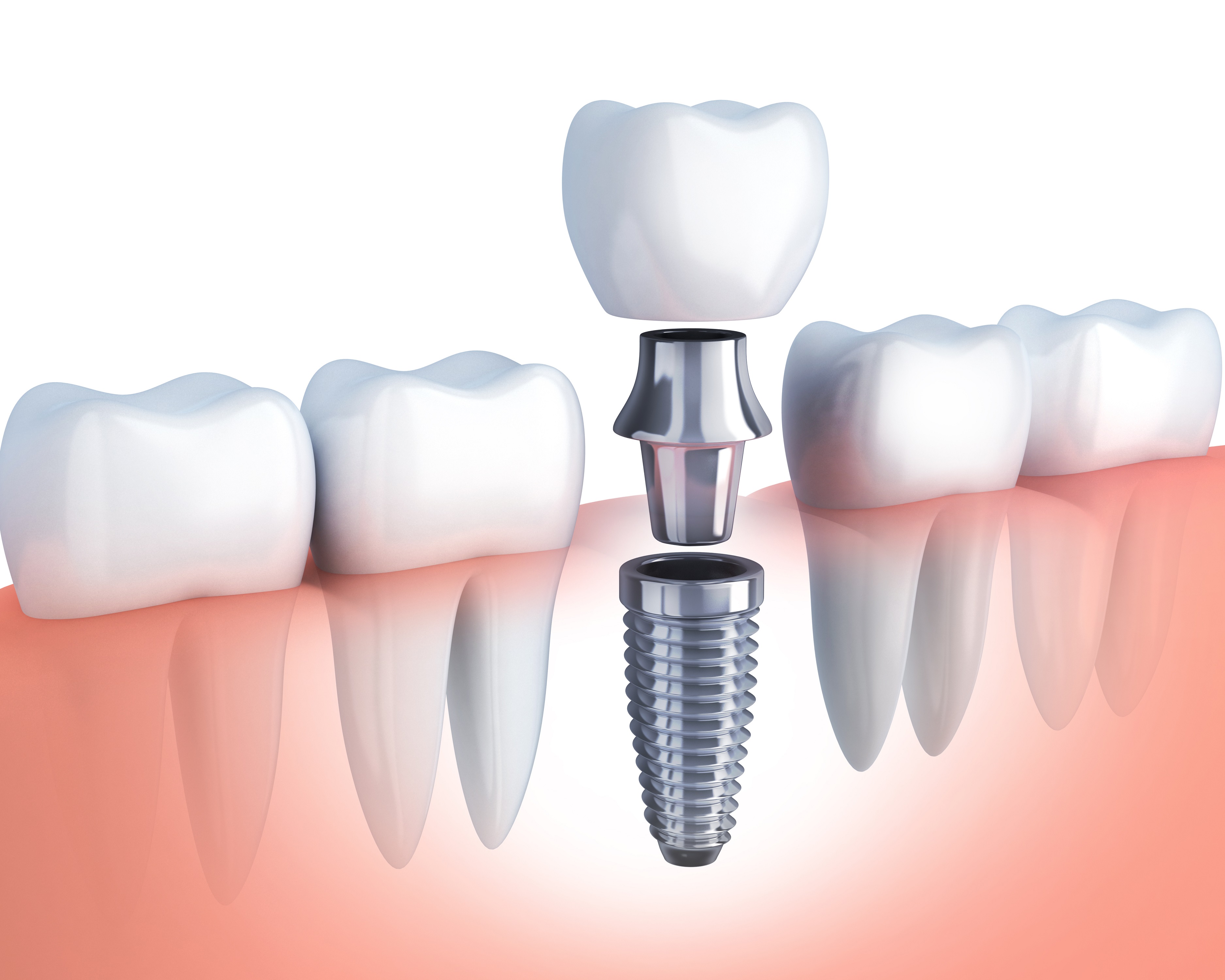 dental implants gainesville fl