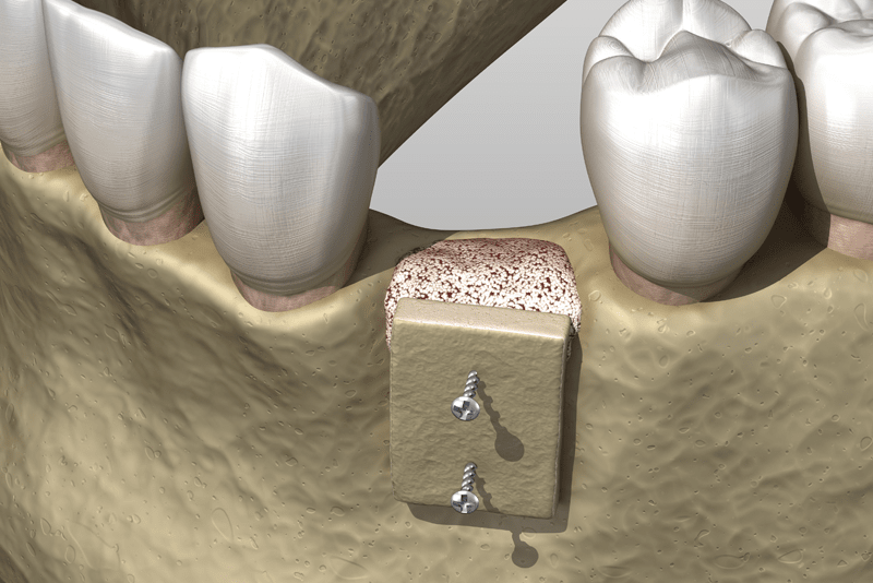 Ridge Augmentation Graphic