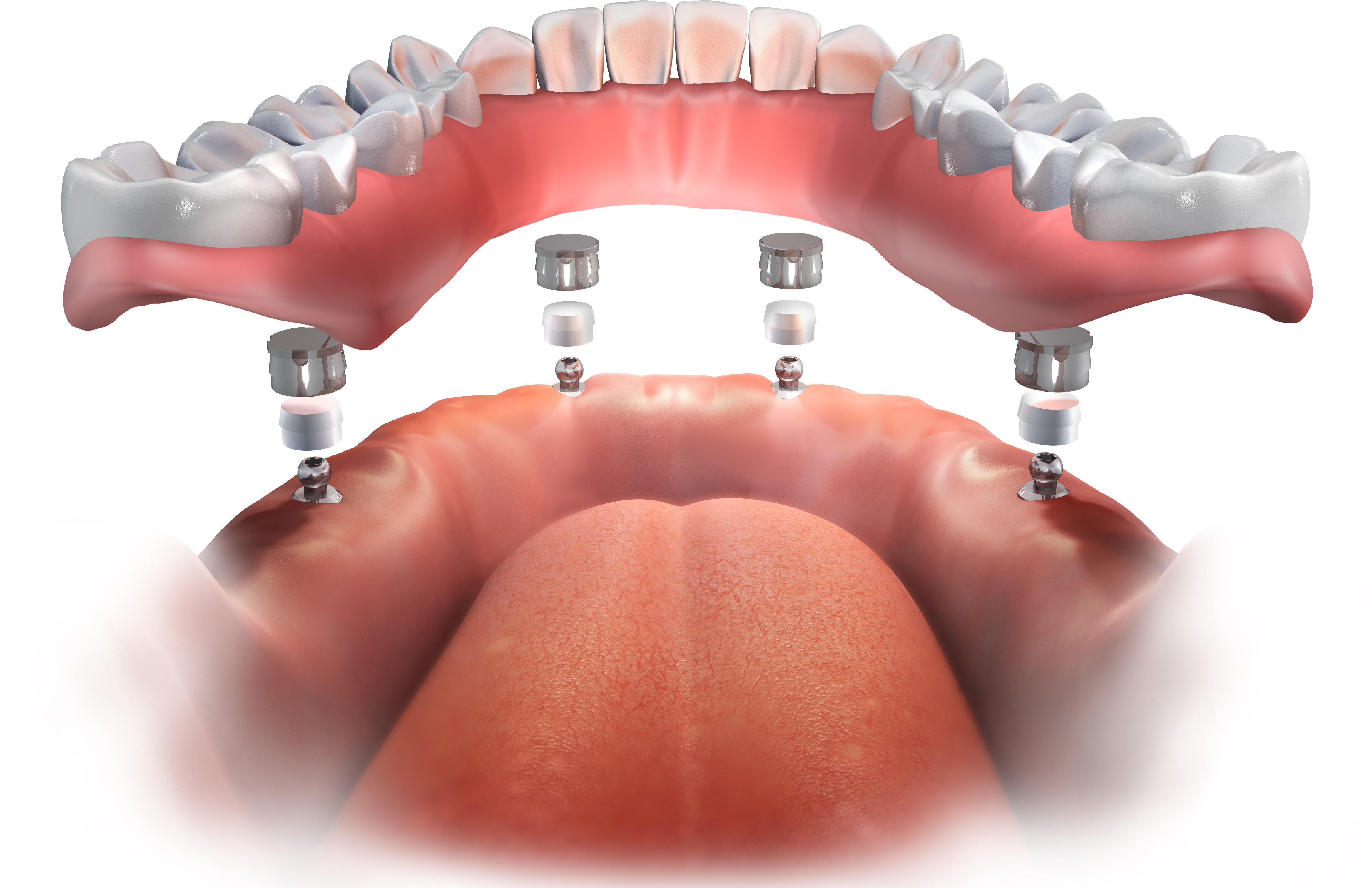 all on 4 dental implants gainesville fl