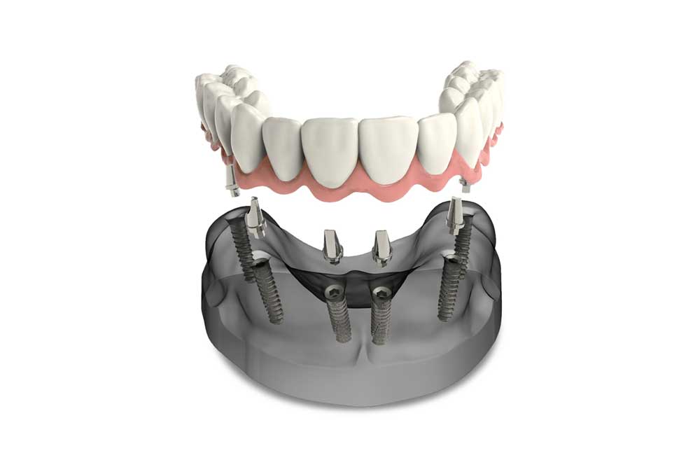 model of full arch dental implants