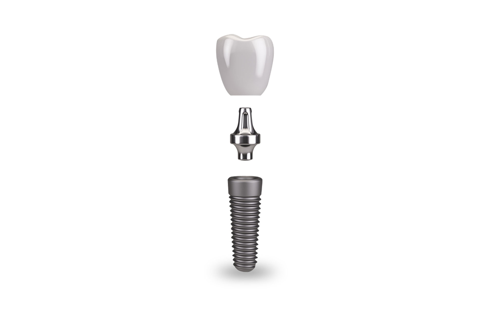 the three components of a dental implant