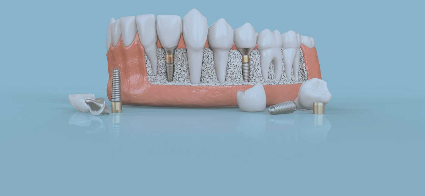 illustration of placed dental implants