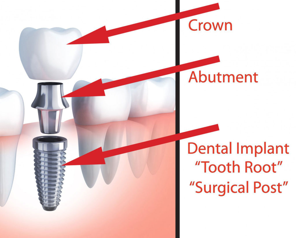 Graphic Showing The Different Parts Of A Dental Implant