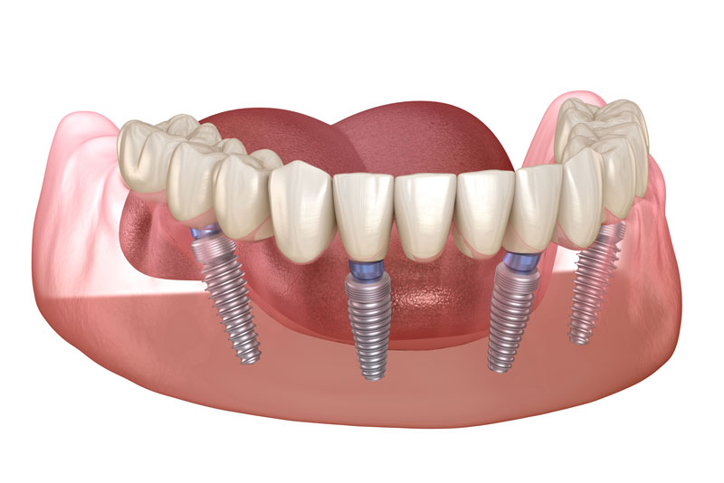 Model Showing An All-On-4 Dental Implant Full Arch