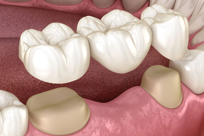 A Model Of Dental Bridges