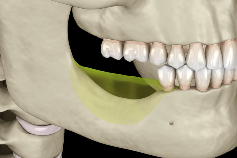 Dental Patient With A Big Chunk Of Jawbone Missing In His Jaw