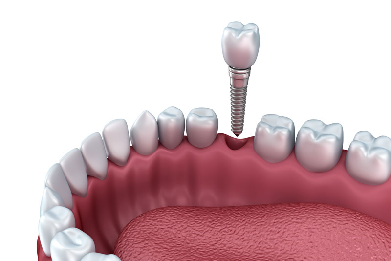 Dental Implant Model