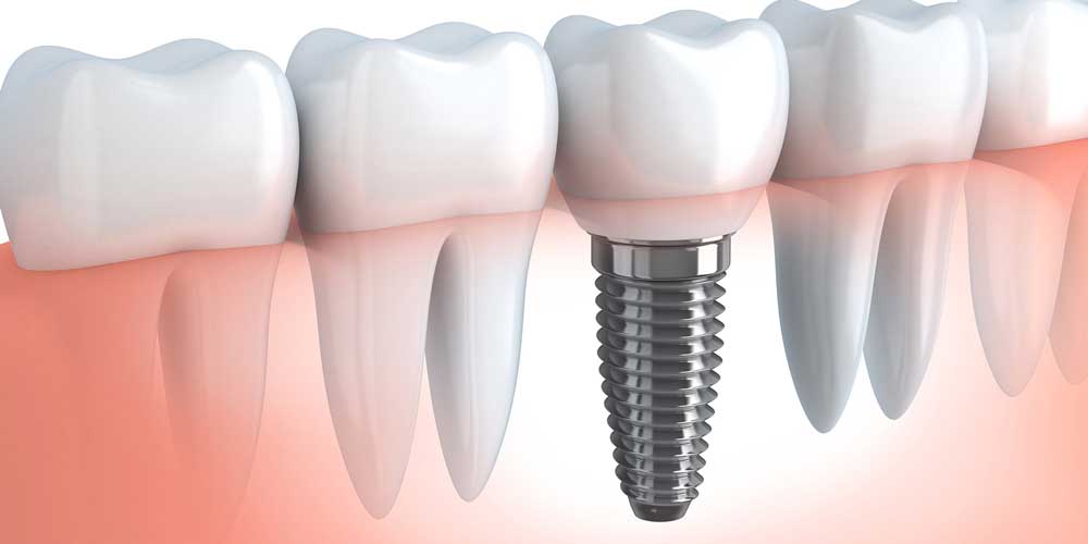 an illustration of a dental implant