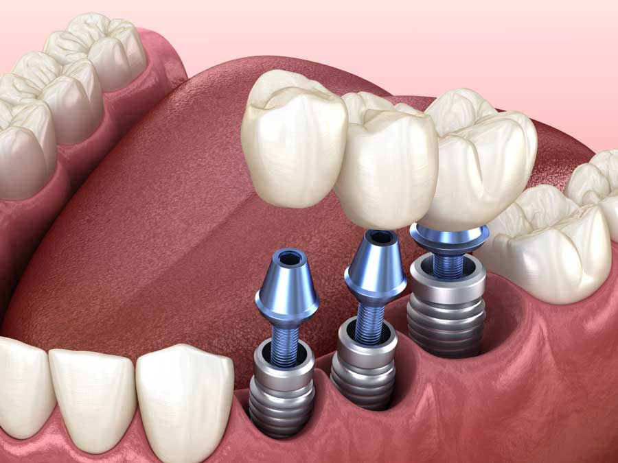 a diagram of three dental implants being placed