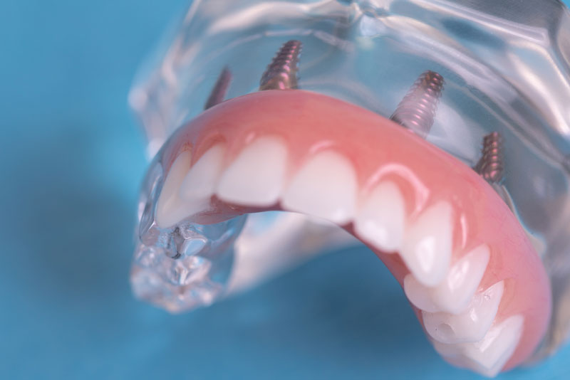 All On Four Dental Implant