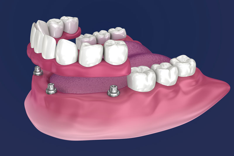 Graphic Of A Partial Denture Being Mounted On Dental Implants
