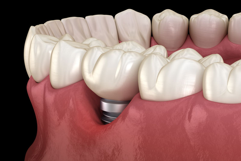 Receded Dental Implant