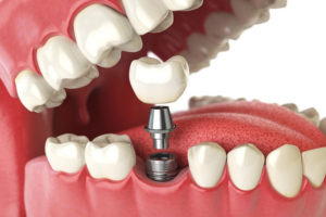 image of a single dental implant being implanted model