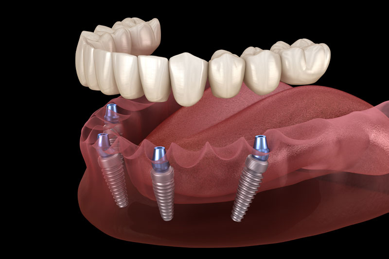 image of a lower arch full mouth dental implant model with four dental implants transparently embedded in the gums with the dental prosthesis hovering above it.