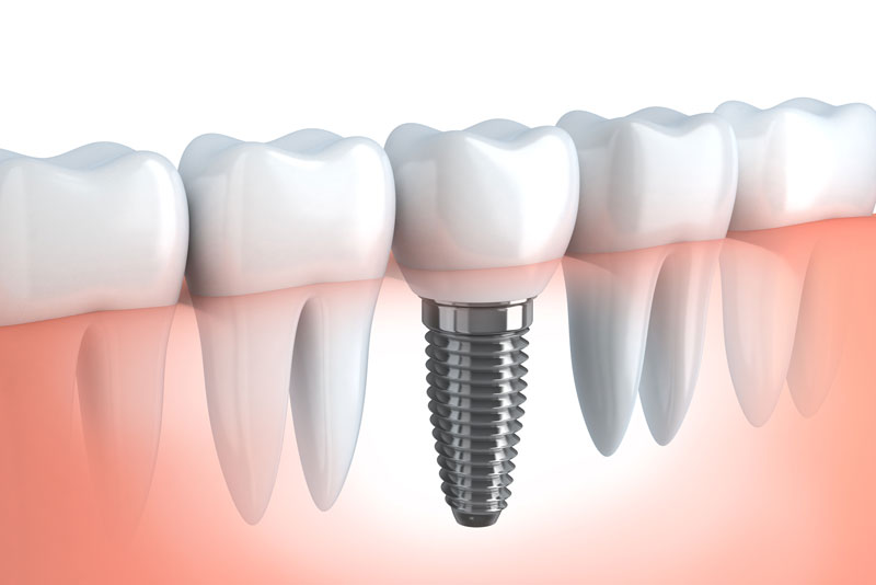 an image of a dental implant, with the dental implant post placed in a transparent gum line, surrounded by natural teeth.