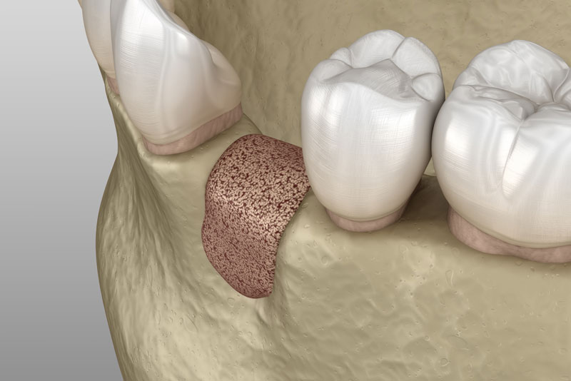 Bone Graft Where A Tooth Is Missing