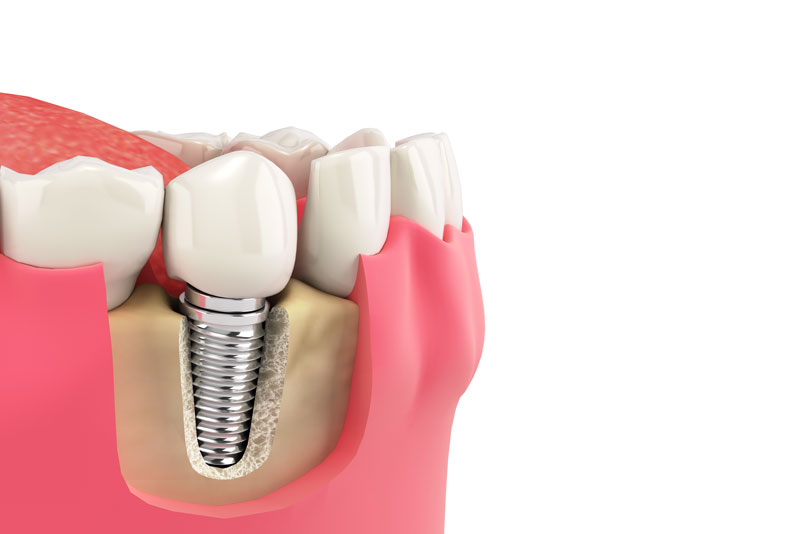 a single dental implant placed in a jawbone 3d model.