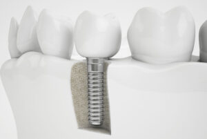 a dental implant that has been surgically placed in the area of the jawbone where a bone grafting procedure was performed. The dental implant is surrounded by natural teeth.