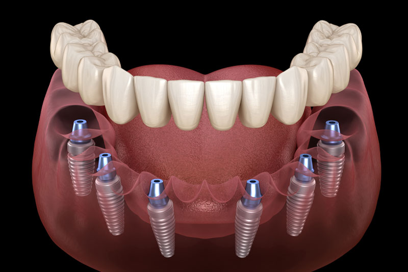 a full mouth dental implant model that shows the six dental implants that can be strategically and precisely placed with digital smile design technology.