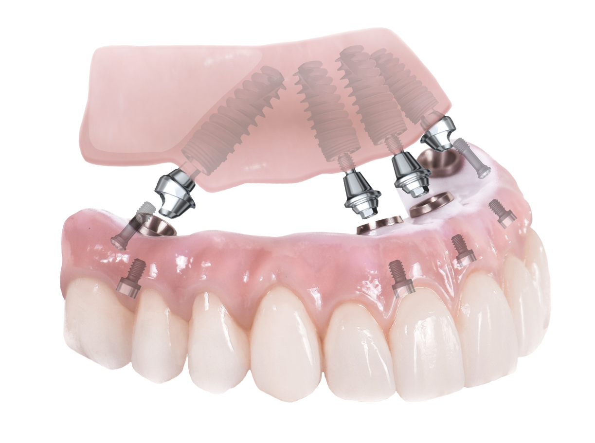 An image of dental implants.
