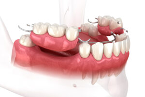 Close-up 3d image of a dental implant