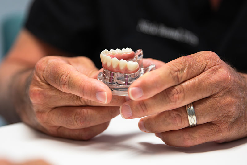 dental implants - options for replacing missing teeth