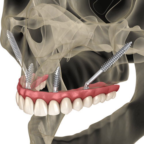 Zygomatic Dental Implants Supporting A Top Arch All On 4 Dental Implant Prosthetic