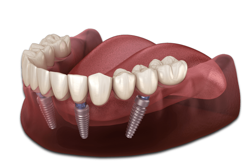 All On 4 Dental Implants With A Zirconia Prosthetic