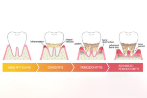 a progressive graph showing the stages of gum health from healthy to advanced periodontitis
