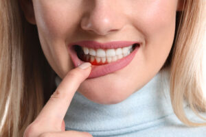 a woman with gum disease showing her inflamed gums