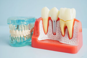 a cut away of the teeth with an implant being shown and a full arch of teeth next to it