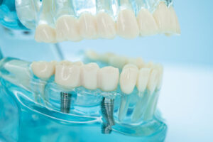 a couple of dental implants placed in the jaw