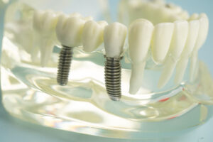 2 single dental implants with crowns on top placed into the clear jaw model
