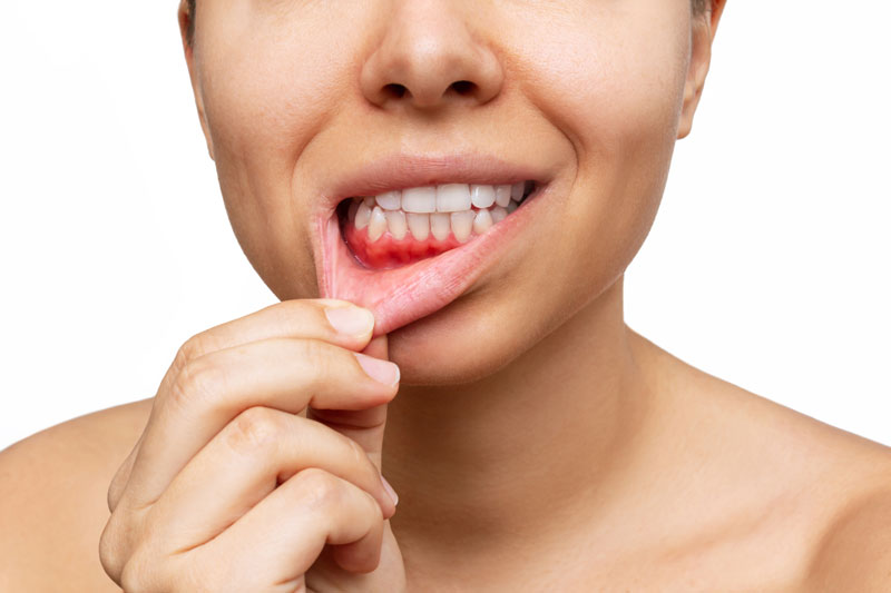 periodontal disease where the gums turn red