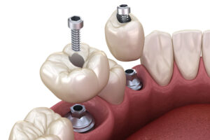 2 single dental implants with crowns being placed on top with screws through the middle