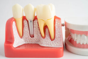 a dental implant model with a full arch sitting next to it