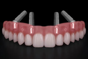 all on 4 dental implants with a full arch going across it
