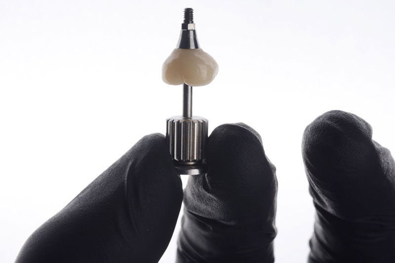 a single dental implant being held in with a crown on top of it