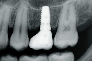 Close up X-Ray showcasing a dental implant seamlessly integrated into the jawbone, replacing a missing tooth. No text on image.