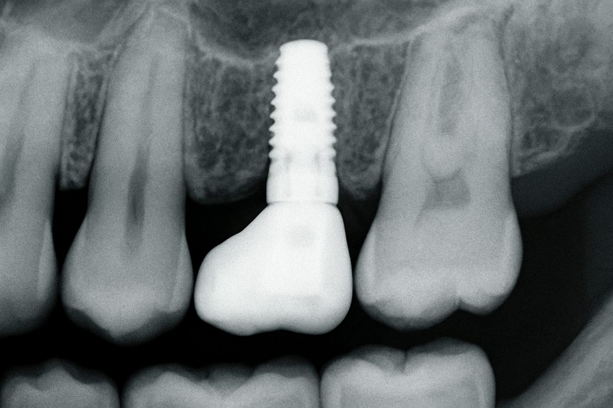 Close up X-Ray showcasing a dental implant seamlessly integrated into the jawbone, replacing a missing tooth. No text on image.
