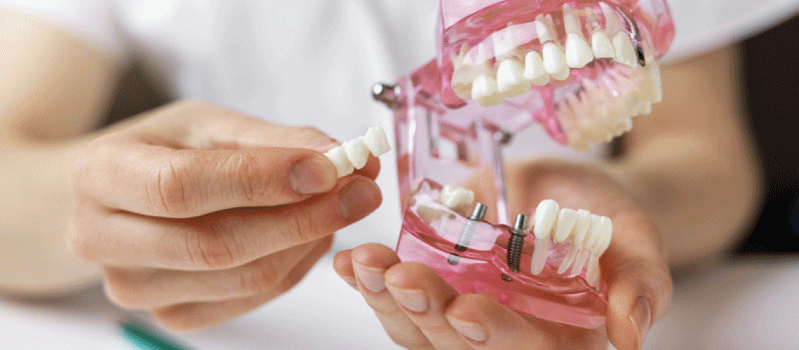 dentist implantologist showing dental bridge implant technology on human tooth jaw model