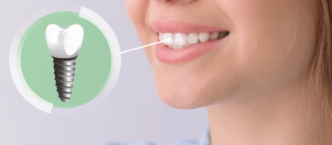 Young woman with implanted teeth on color background, closeup